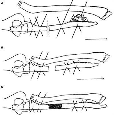 Modified gradual ulnar lengthening for treatment of Masada type IIb forearm deformity in children with hereditary multiple osteochondromas